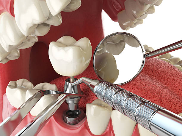 Best Emergency Tooth Extraction in Centuria, WI